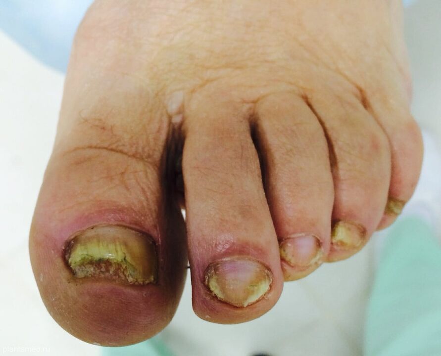 champignon avancé des ongles des pieds