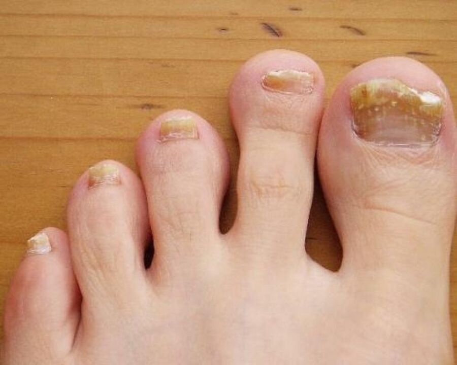 jaunissement de la plaque à ongles dû à un champignon