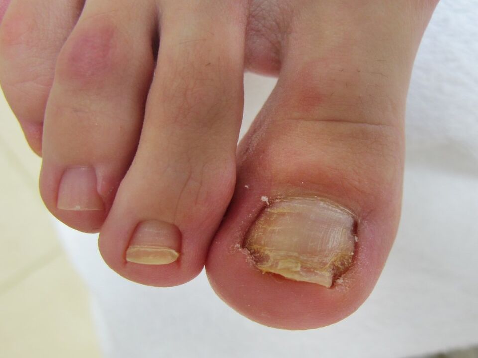 symptômes de la mycose des ongles des pieds