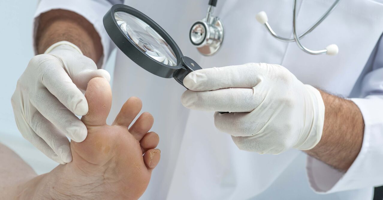un médecin examine les pieds à la recherche de mycose des ongles