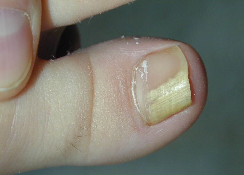 infection fongique de la plaque à ongles