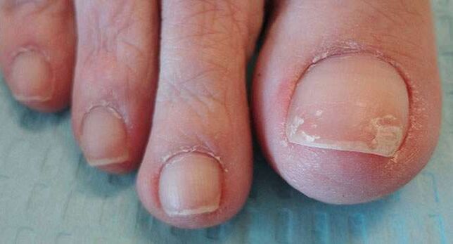 L'un des symptômes de l'onychomycose est le détachement de la plaque de l'ongle. 