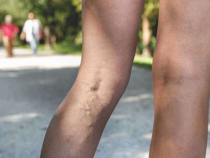 Les varices sont un facteur de risque d'infection fongique du pied