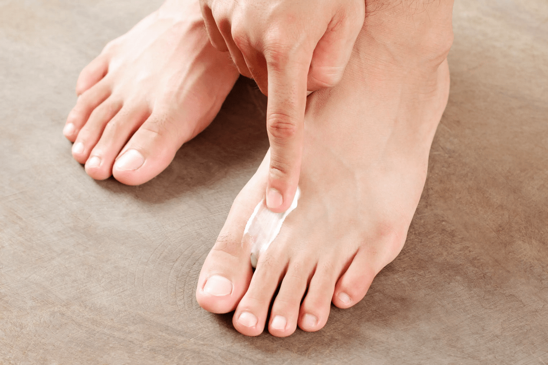 appliquer une pommade antifongique sur la peau du pied