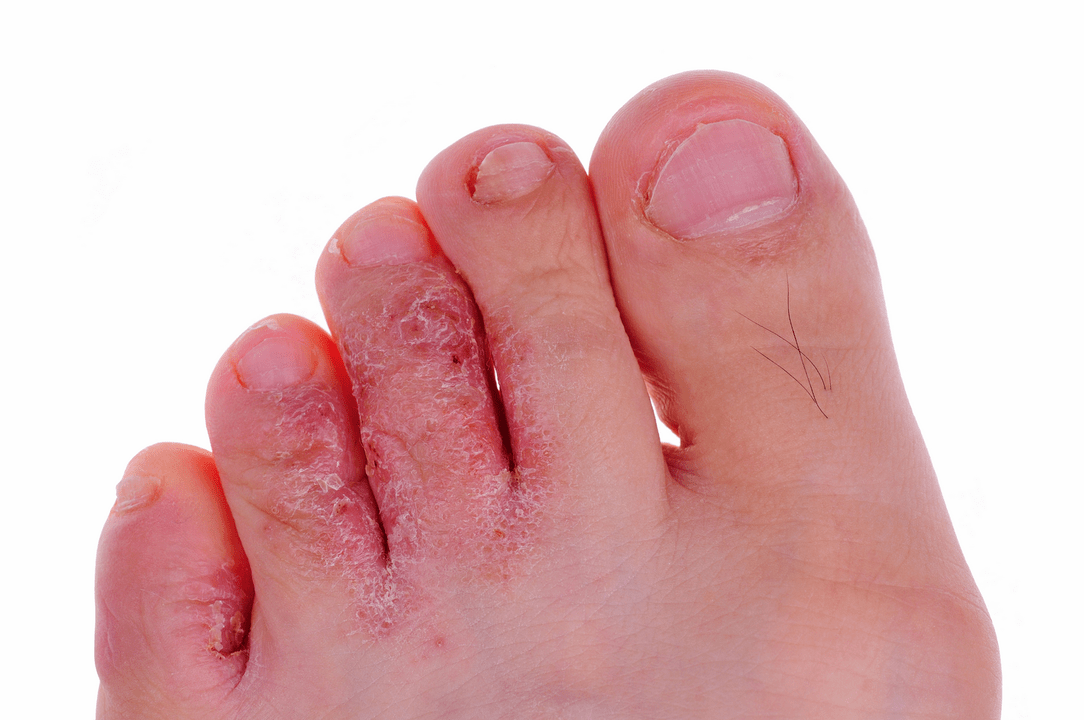 infection fongique de la peau entre les orteils