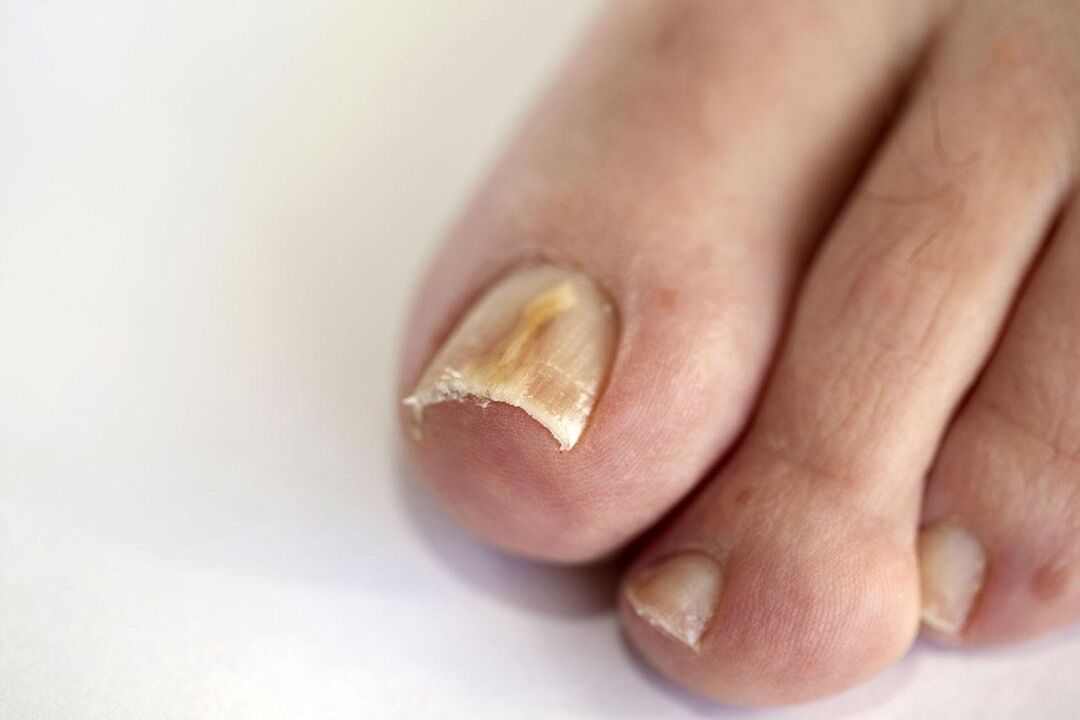 symptômes de la mycose des ongles des pieds