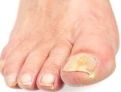Après le bain, l'ongle affecté est plus facile à retirer