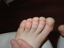 Le champignon des ongles se produit même chez les enfants