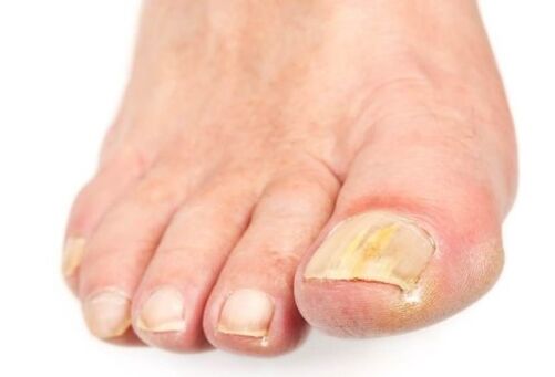 Champignon sur les ongles