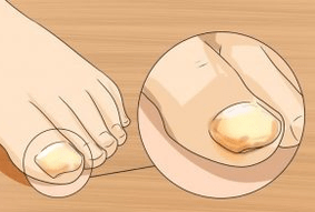 Champignon de clou