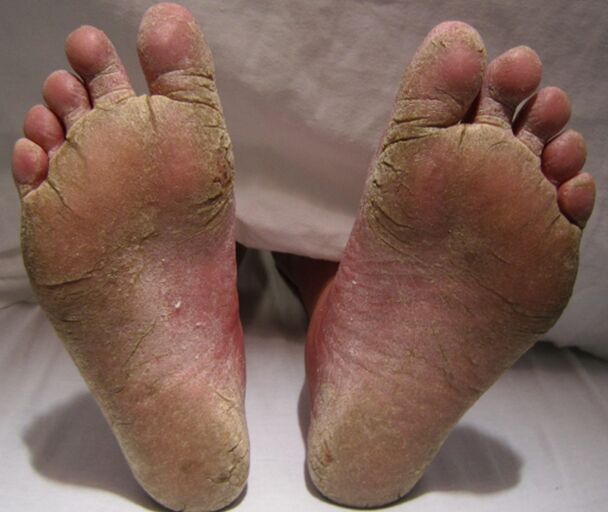 Défaite mycotique des pieds