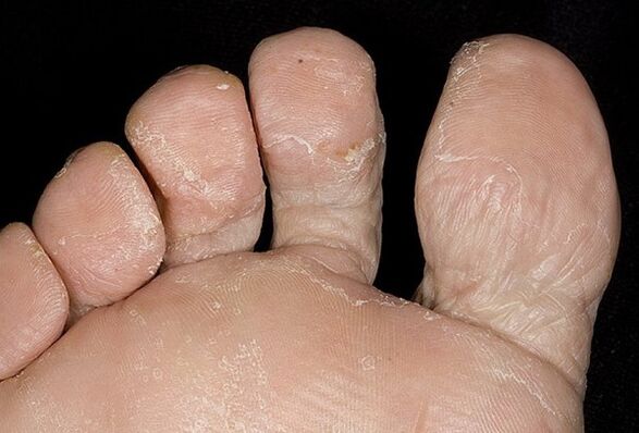 Types de champignons des jambes