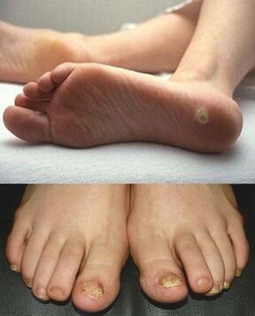 Le champignon sur les jambes