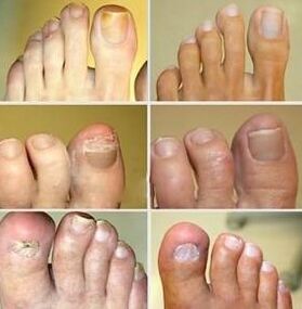 Déformation de l'ongle
