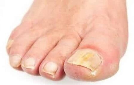 L'étape initiale du champignon sur l'ongle du pied