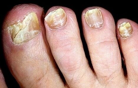 Les ongles s'effondrent du champignon