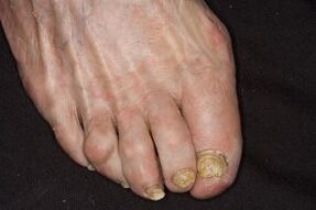 Traitement des champignons à ongles sur les jambes du vinaigre de cidre de pomme