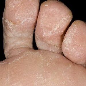 stades de la mycose des ongles