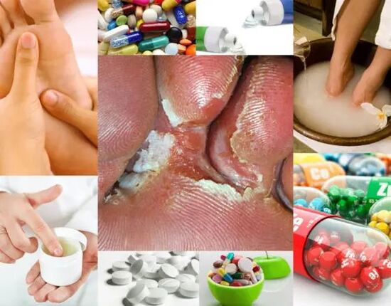 Mycose interdigitale et méthodes de traitement