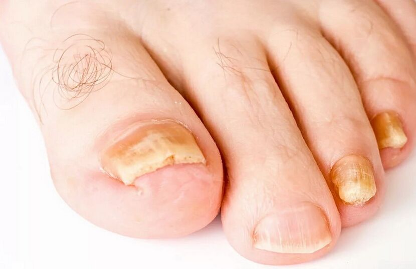 champignon des ongles