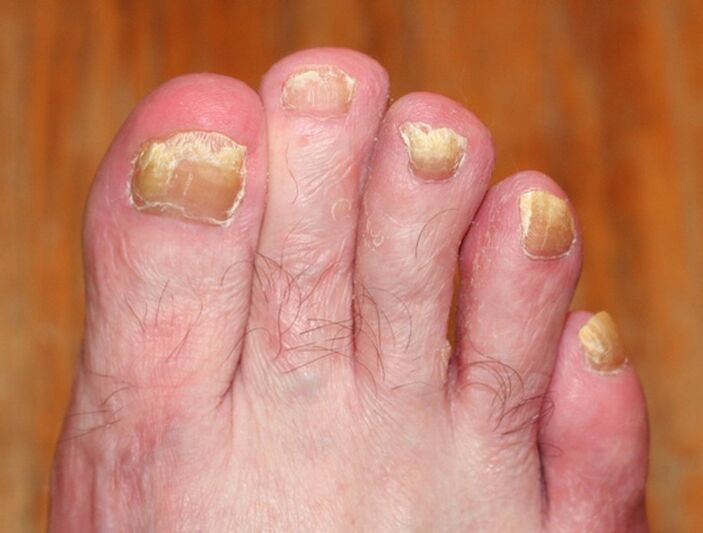 forme avancée de mycose des ongles