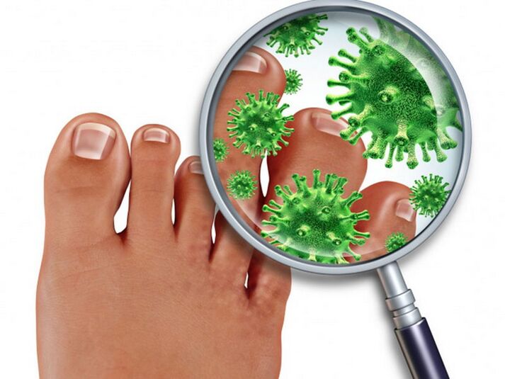 infection fongique