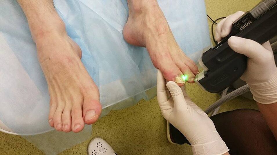 thérapie au laser pour les mycoses des ongles