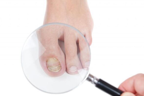 stades et stades de développement du champignon sur les ongles des pieds