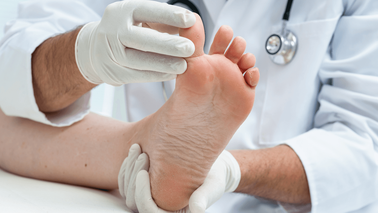 Diagnostic de champignon du pied