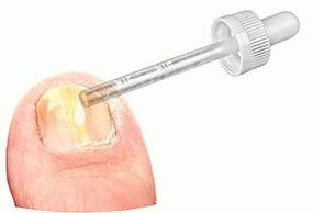 Appliquer des gouttes médicinales sur un ongle atteint de champignon