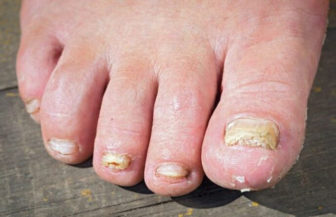 Champignon rubromycose sur les pieds