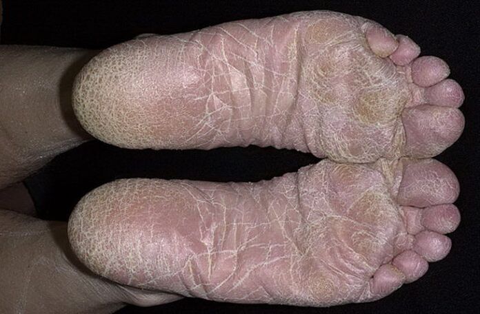 champignon du pied