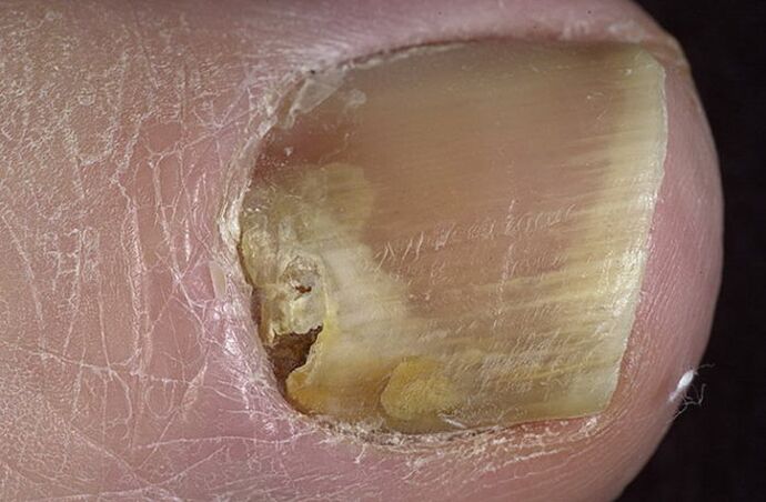 champignon sur les ongles
