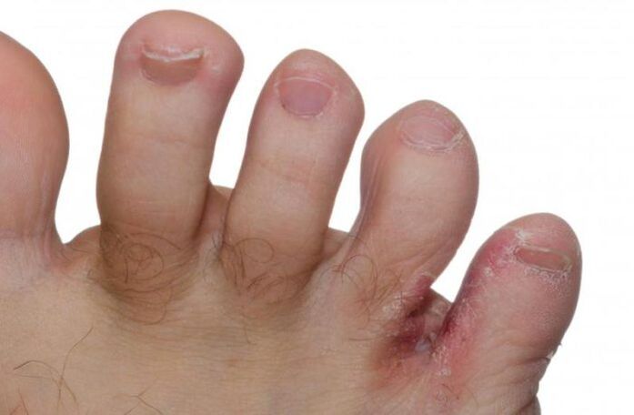 champignon sur les pieds entre les orteils