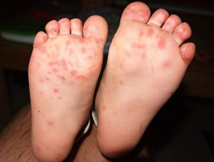 champignon vésiculaire sur les jambes