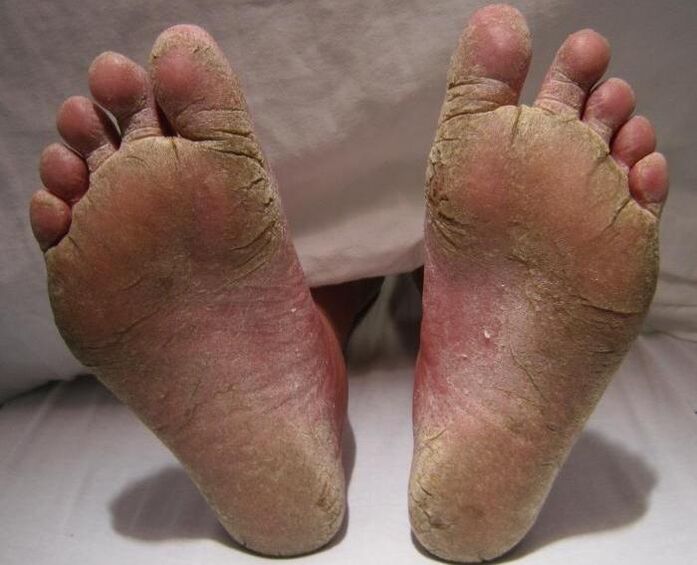 champignon épidermoïde-hyperkératique sur les jambes