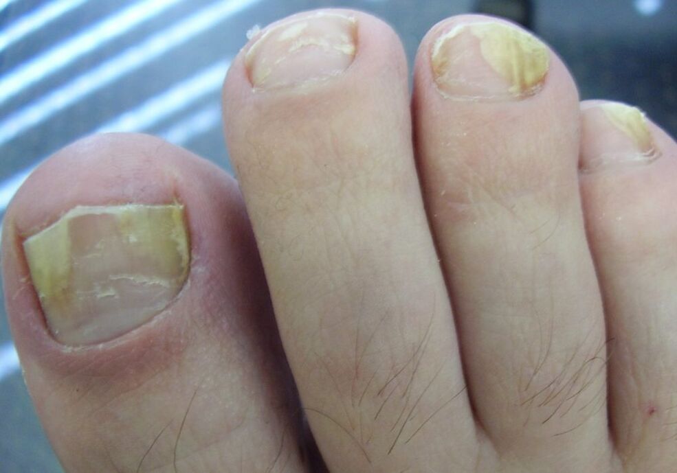 Couleur jaune de la plaque à ongles au deuxième stade de l'infection fongique