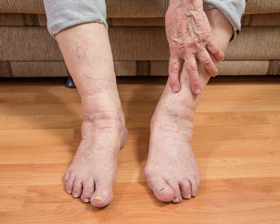 Pour éviter la propagation des microspores fongiques, ne marchez pas pieds nus à la maison.