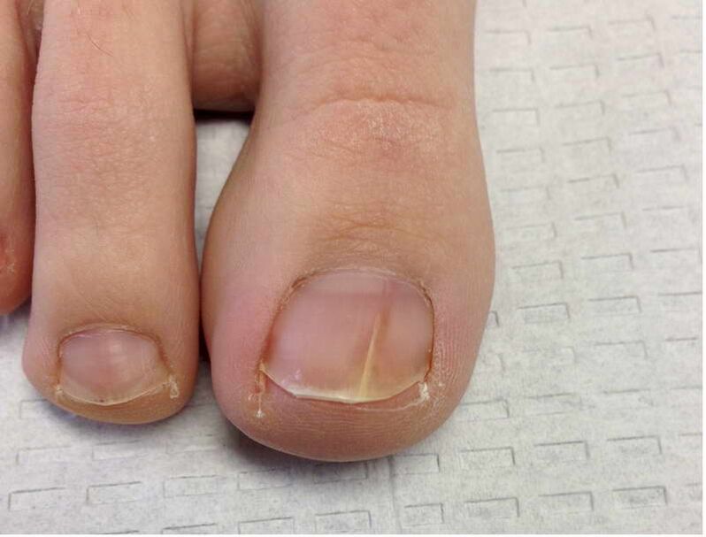 Rayures et taches sur l'ongle du gros orteil au cours de la première étape du développement fongique