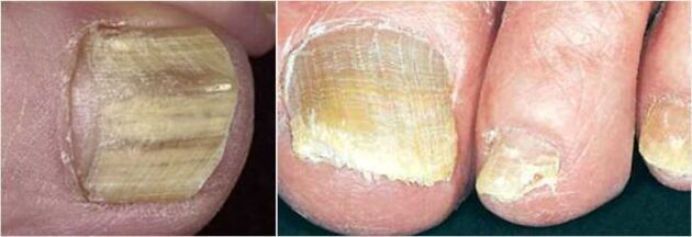 Forme avancée de mycose des ongles des pieds