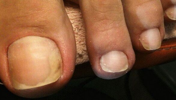 Signes du stade initial de la mycose des ongles des pieds