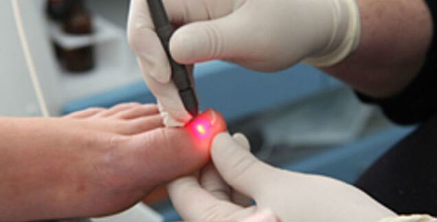 Thérapie au laser pour les mycoses des ongles des pieds